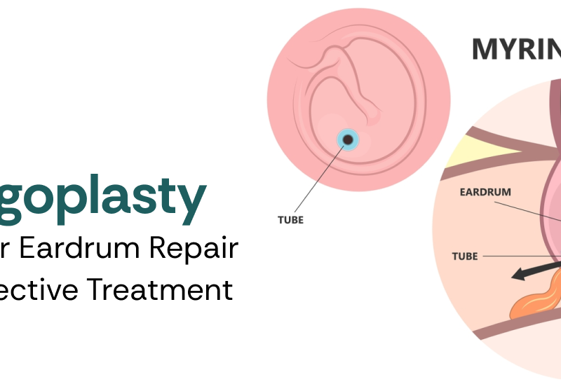 Myringoplasty Surgery for Eardrum Repair – Safe & Effective Treatment