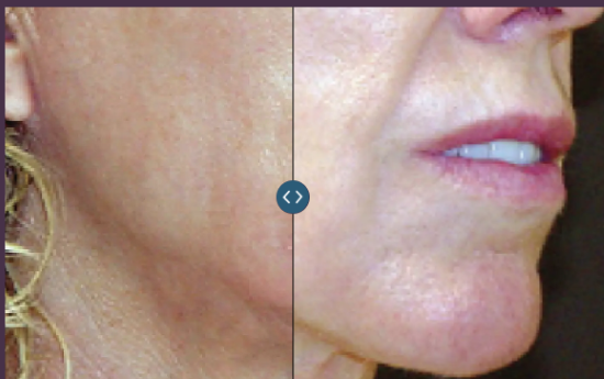 Thermage Skin Tightenng