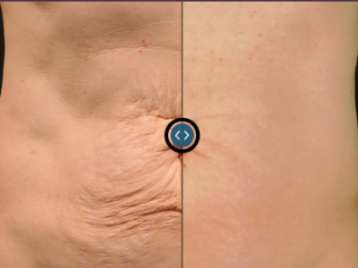 Thermage Skin Tightenng