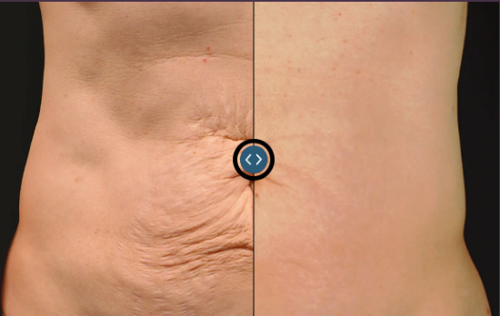 Thermage Skin Tightenng