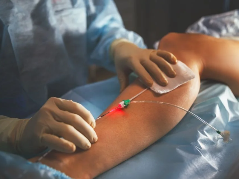 Modern Laser Technology for Vein Treatment