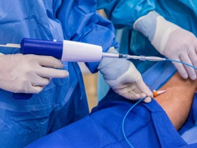 Minimally Invasive VenaSeal Solution for Varicose Veins