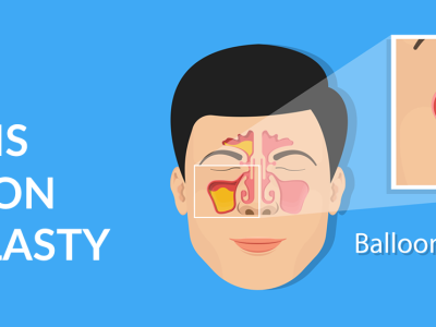 What Is Balloon Sinuplasty? Safe & Effective Sinus Treatment