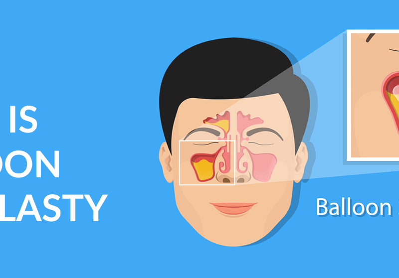 What Is Balloon Sinuplasty? Safe & Effective Sinus Treatment
