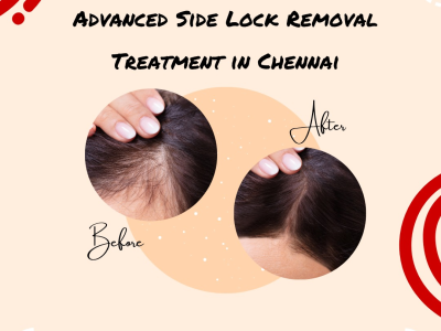 Advanced Side Lock Hair Removal Treatment in Chennai