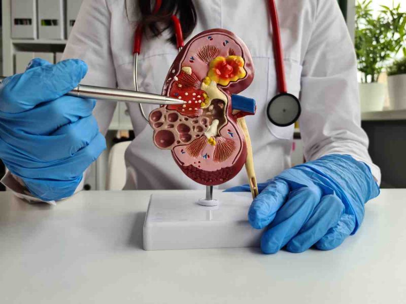 Chronic Kidney Disease Doctor for Long-Term Kidney Management