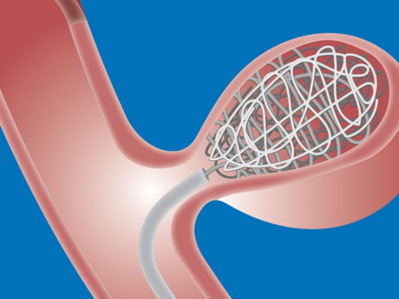 Aneurysm Coiling – Safe, Minimally Invasive Brain Aneurysm Treatment | IR Facilities