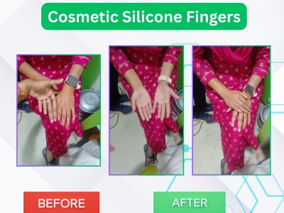Best Artificial Leg in Hyderabad | CareVale Prosthetics