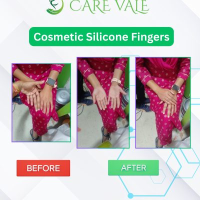 carevale orthotics