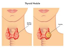 Thyroid Nodule Treatment: Non-Surgical Approach for Precise and Lasting Results