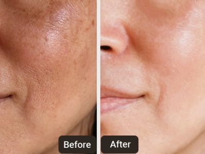 4 Things a Skin Dr in Chandigarh Wants You to Know About Facials & Clean Up