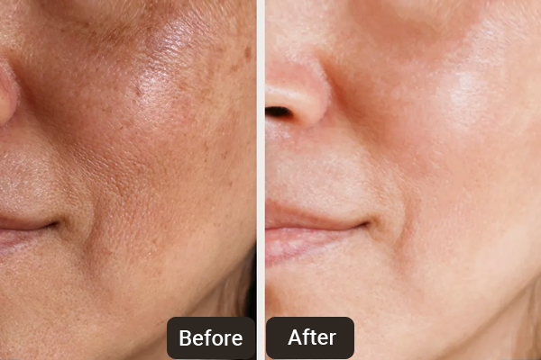 4 Things a Skin Dr in Chandigarh Wants You to Know About Facials & Clean Up