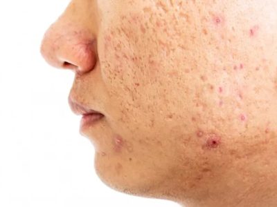Best Acne Scar Treatment in Delhi by Expert Dermatologists