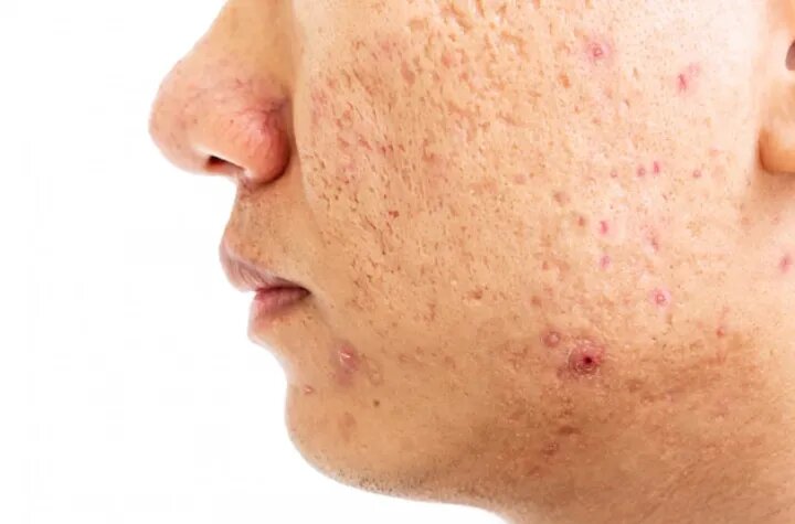 Best Acne Scar Treatment in Delhi by Expert Dermatologists