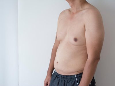Best Gynecomastia Surgery in Mumbai by Experienced Surgeons