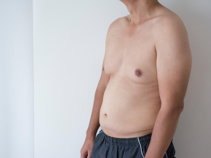 Best Gynecomastia Surgery in Mumbai by Experienced Surgeons