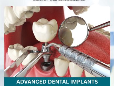 Advanced Dental Implants Treatment — Vanasthalipuram Clinic