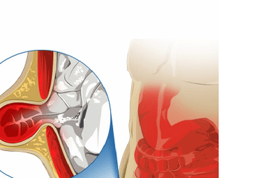 Expert Incisional Hernia Repair and Robotic Hernia Repair in Chennai
