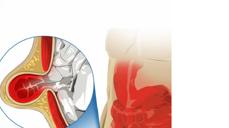 Expert Incisional Hernia Repair and Robotic Hernia Repair in Chennai
