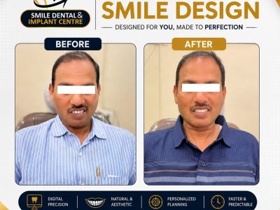 Digital Smile Design Before and After | Smile Dental & Implant Centre
