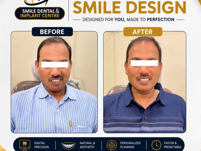 Digital Smile Design Before and After | Smile Dental & Implant Centre
