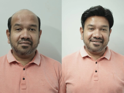 Hair Patch in Jaipur | Natural & Non-Surgical Hair Solutions
