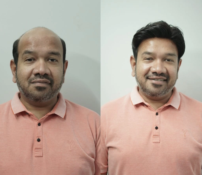 Hair Patch in Jaipur | Natural & Non-Surgical Hair Solutions
