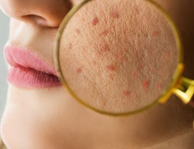 Trusted Acne & Scar Removal Experts in Chandigarh - CosmetiCare