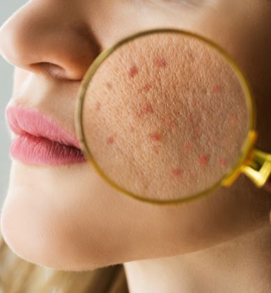 Trusted Acne & Scar Removal Experts in Chandigarh - CosmetiCare
