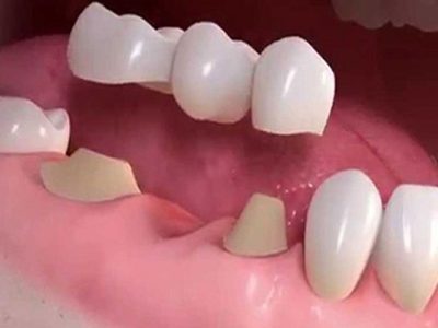 Artificial Teeth Services in Indore Dr Atul Jajoo