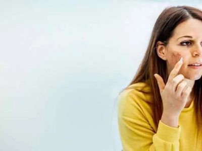 Acne Scar Treatment in Noida | Expert Skin Care