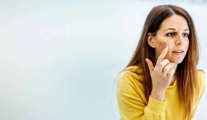 Acne Scar Treatment in Noida | Expert Skin Care