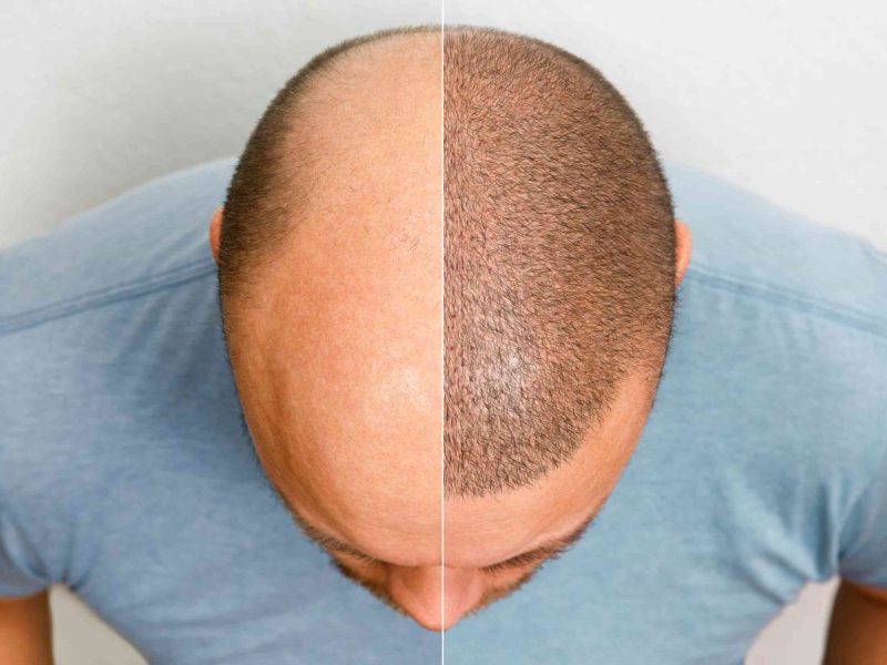 Best Hair Transplant in Noida by Expert Hair Surgeons