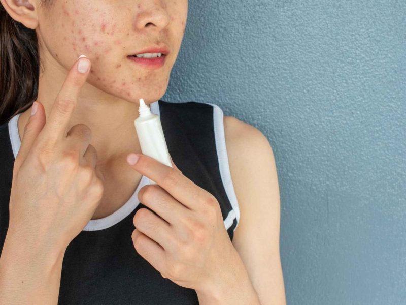 Acne Treatment in Noida – Say Goodbye to Pimples and Breakouts