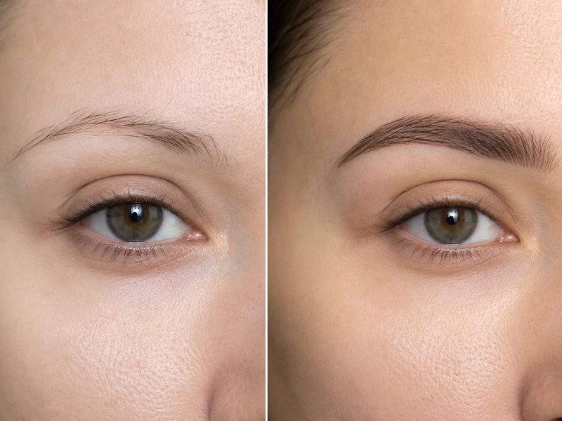 Expert Eyebrow Transplant UK Cost Consultation
