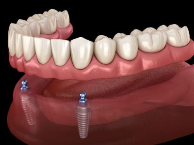 Long Lasting Dental Implants in Punawale by Dr Hileri Mori Pune