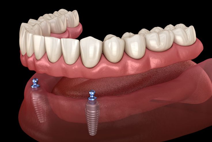 Long Lasting Dental Implants in Punawale by Dr Hileri Mori Pune