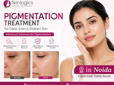 Laser Pigmentation Treatment in Noida – Safe & Effective