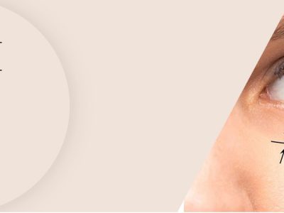 Eyelid Surgery in Mumbai – Expert Blepharoplasty Solutions
