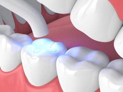 Restore Your Smile with Composite Teeth Filling | Meditouring