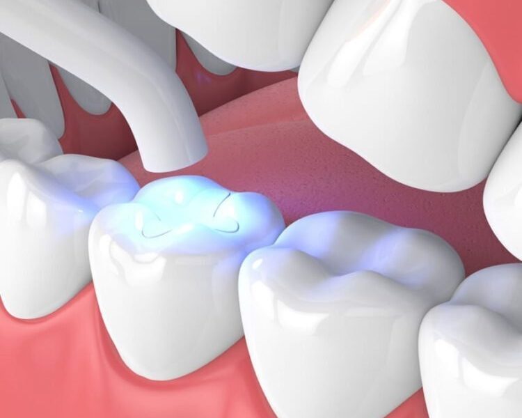 Restore Your Smile with Composite Teeth Filling | Meditouring