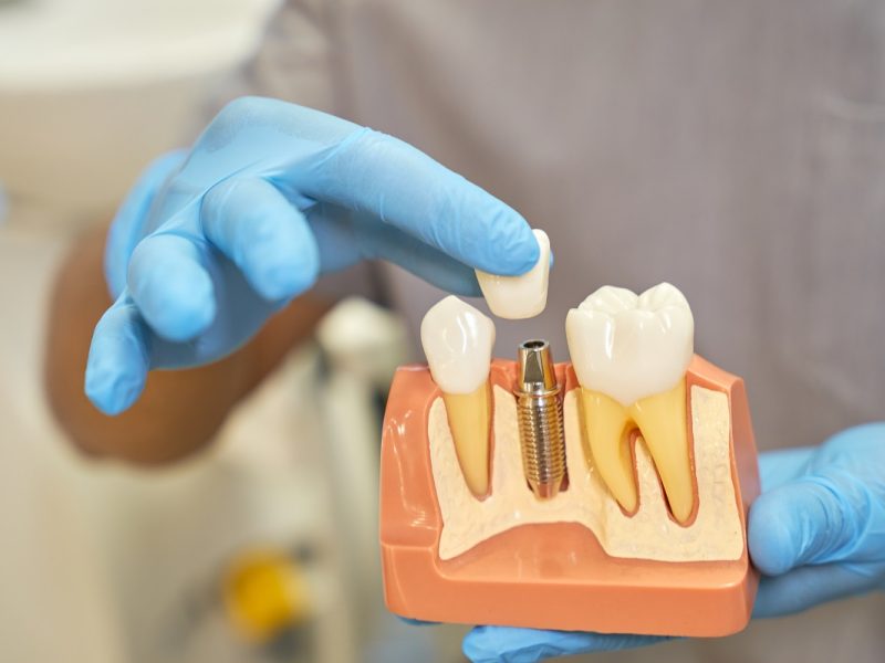 Dental Implants in El Paso TX | Personalized Tooth Replacement Solutions