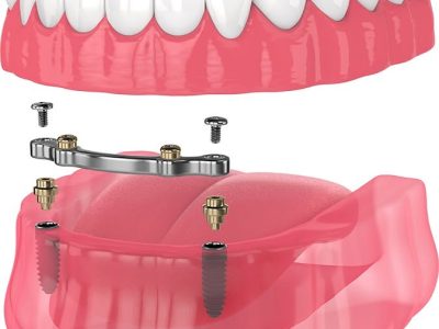 Emergency Dentist 24/7 Denver