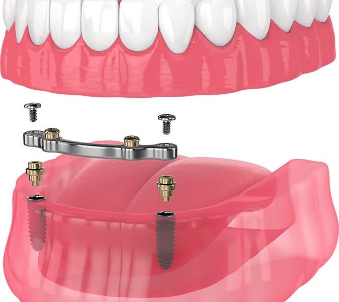 Emergency Dentist 24/7 Denver