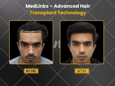 Restore Your Hair with Hair Transplant in Faridabad at MedLinks