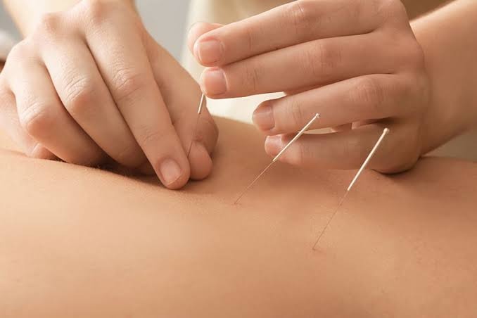Pain Management Acupuncture in NYC | Back, Neck & Sciatica Relief