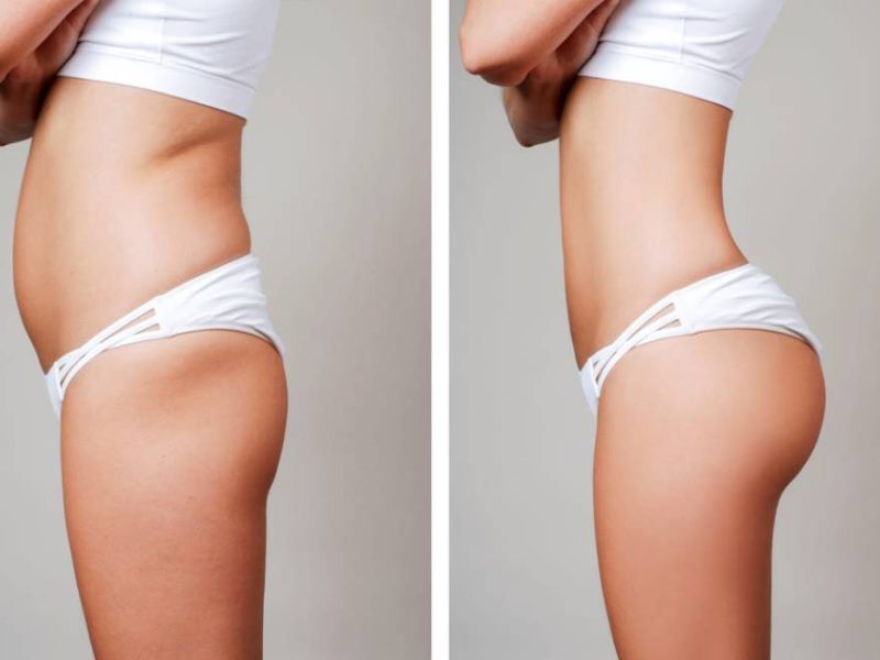 Get a Slimmer Shape with Liposuction in Mumbai