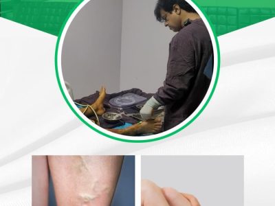 Cost for Varicose Vein Treatment in India – All You Need to Know