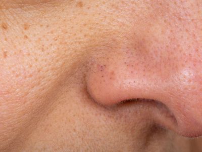 Open Pores Treatment in Noida – Smoother Skin Is Possible