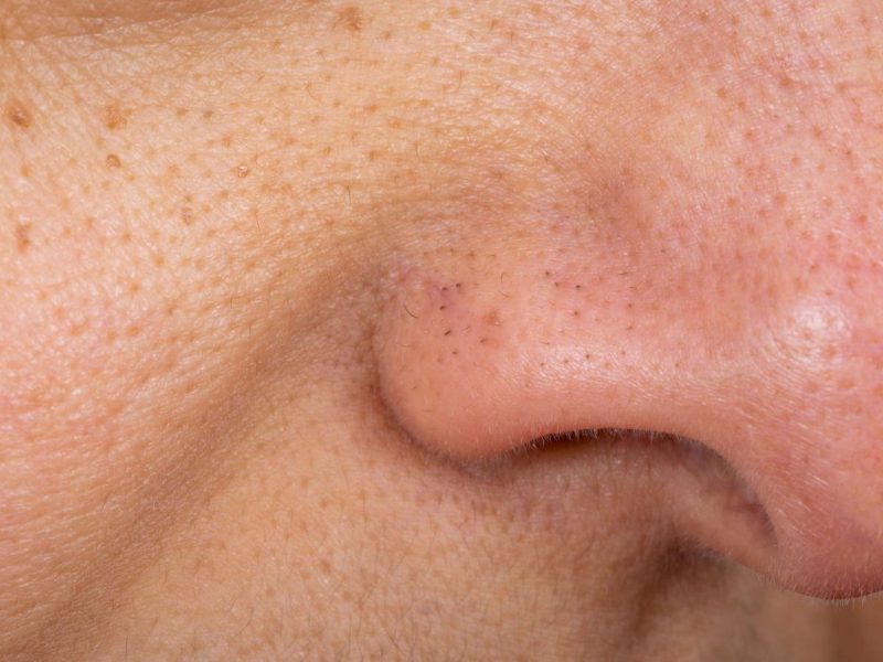 Open Pores Treatment in Noida – Smoother Skin Is Possible